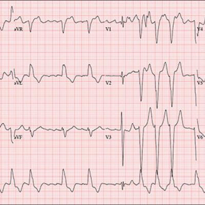 “Spry” Woman Reports Rapid Heart Rate | Clinician Reviews