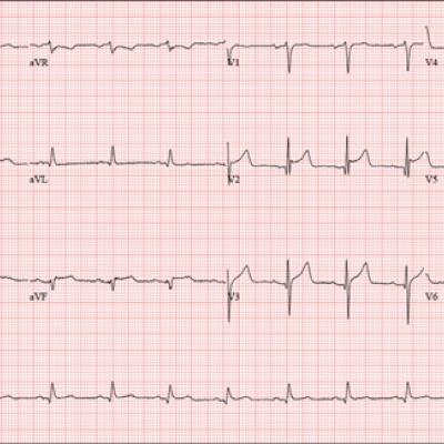 Man Collapses While Playing Basketball | Clinician Reviews