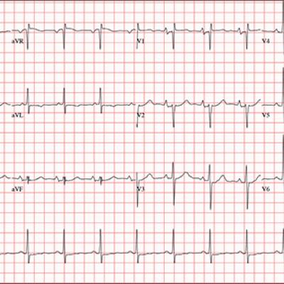 Persistent Cough, Peculiar Heart Sound | Clinician Reviews