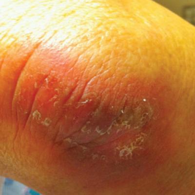 Dermatologic Toxicity in a Patient Receiving Liposomal Doxorubicin ...