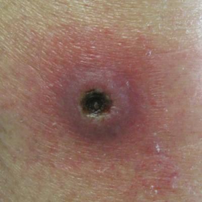 Rare Angioinvasive Fungal Infection in Association With Leukemia Cutis