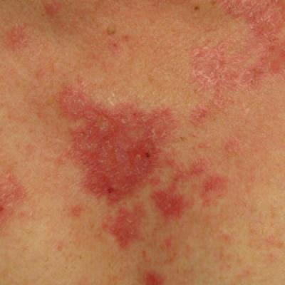 Imiquimod-Induced Subacute Cutaneous Lupus Erythematosus–like Changes ...