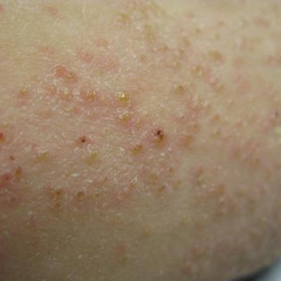 Dry Scaly Rash | MDedge Dermatology