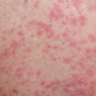 Sweet Syndrome Presenting With an Unusual Morphology | MDedge Dermatology