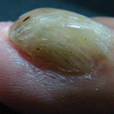 Onychomatricoma: An Often Misdiagnosed Tumor of the Nails | MDedge  Dermatology