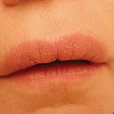 Granulomatous Cheilitis: A Stiff Upper Lip | MDedge Dermatology