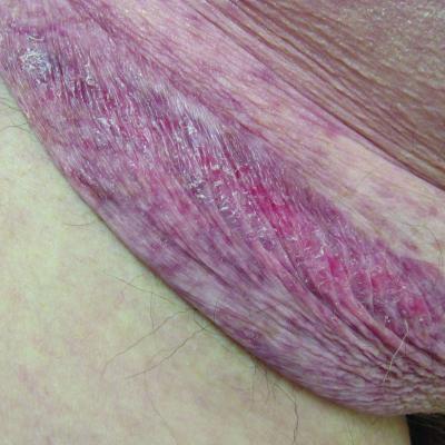 Skin condition in groin area : r/velvethippos