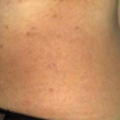 Cutaneous T Cell Lymphoma In A Patient With Celiac Disease Mdedge Dermatology