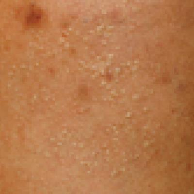 Primary Cutaneous Dermal Mucinosis on Herpes Zoster Scars | MDedge ...