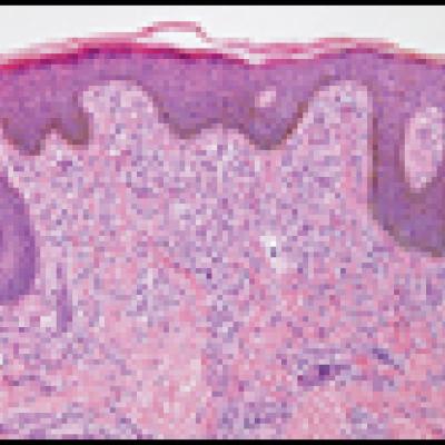 telangiectasia macularis eruptiva perstans histology