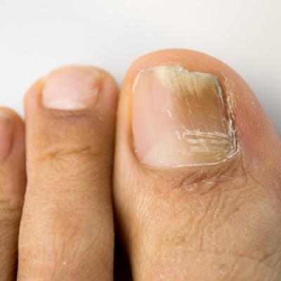 right great toe onychomycosis icd 10
