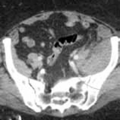 Case Report: Spontaneous Retroperitoneal Bleeding Masking as Left Lower ...