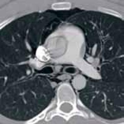 Case Report: Sudden Chest Pain Following an Asthma Attack | MDedge ...