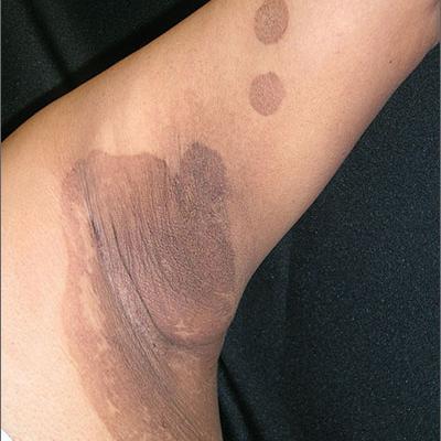 Itchy rash in axillae | MDedge Family Medicine