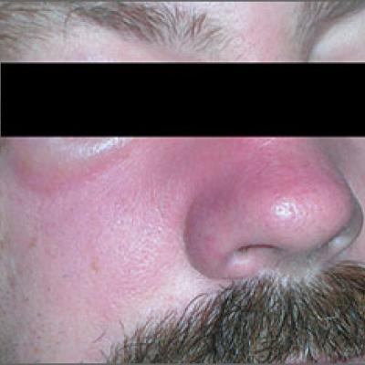 Swollen nose and cheek | MDedge Family Medicine