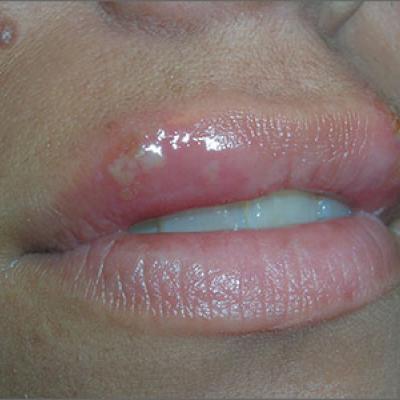 Can Stress Cause Sores On Lips Lipstutorial Org