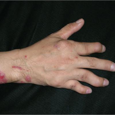 Red rash and finger deformities | MDedge Family Medicine