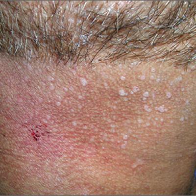 How to remove papilloma on neck