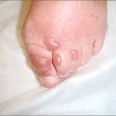 Blisters on toes | MDedge Family Medicine