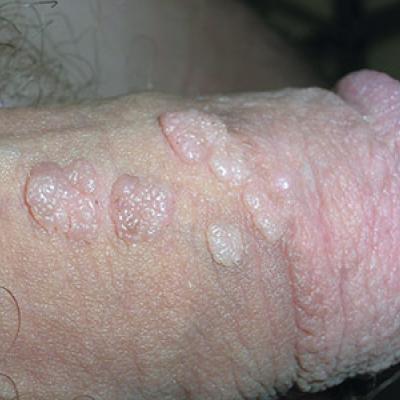 hpv uncircumcised warts
