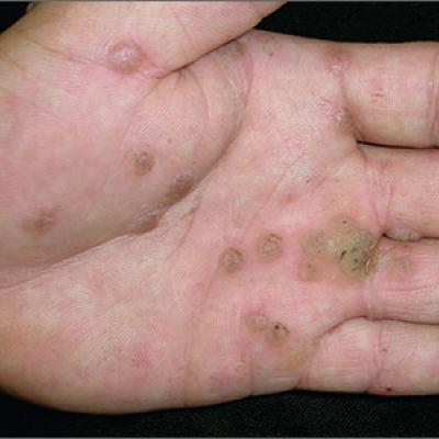 black warts on hands