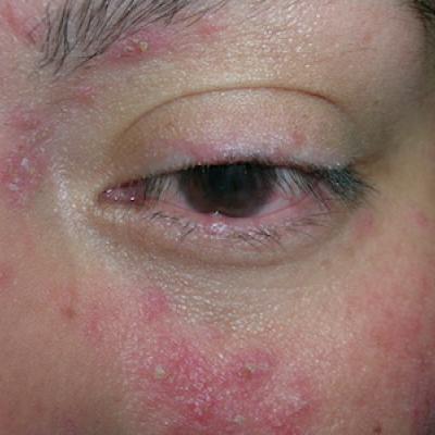 Diminished vision and face papules | MDedge Family Medicine