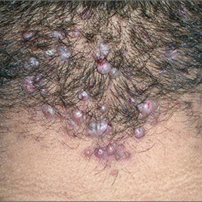 Lesions On Back Of Neck Mdedge Family Medicine