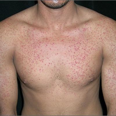 Pruritic rash on chest  MDedge Family Medicine