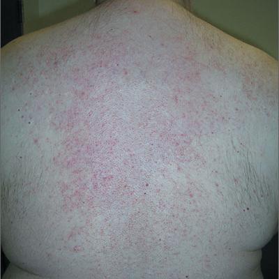 rashes on lower back