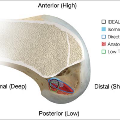 Rationale For Strategic Graft Placement In Anterior Cruciate Ligament Reconstruction I D E A L Femoral Tunnel Position Mdedge Surgery