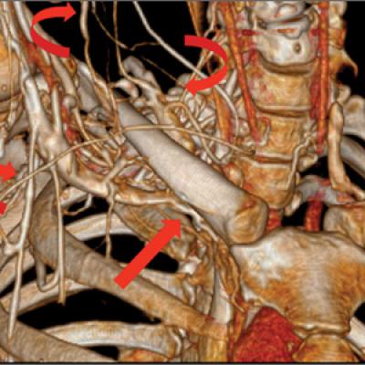 Medical illustration detailing thoracic outlet syndrome. Throw