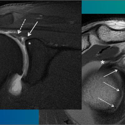 Imaging Evaluation of Superior Labral Anteroposterior (SLAP) Tears ...