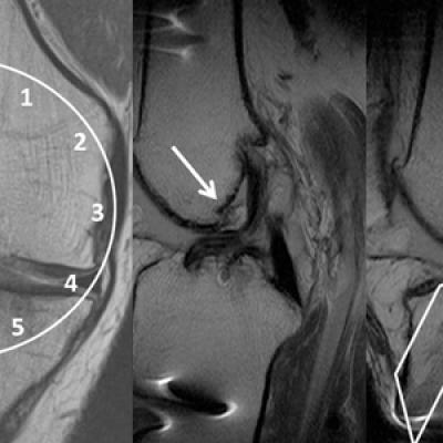 Magnetic Resonance Imaging Of Complications Of Anterior Cruciate ...