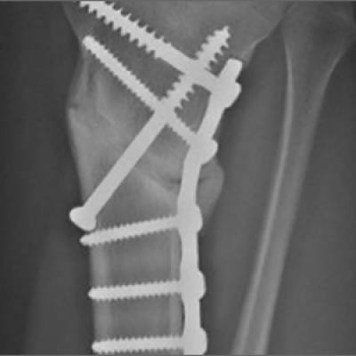 Complete Closing Wedge Osteotomy for Correction of Blount Disease ...