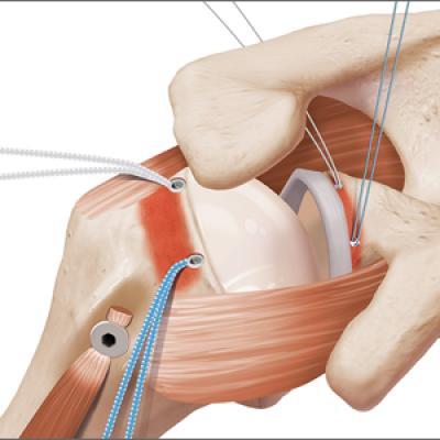 The Arthroscopic Superior Capsular Reconstruction | MDedge Surgery