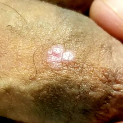 warts on penile skin treatment