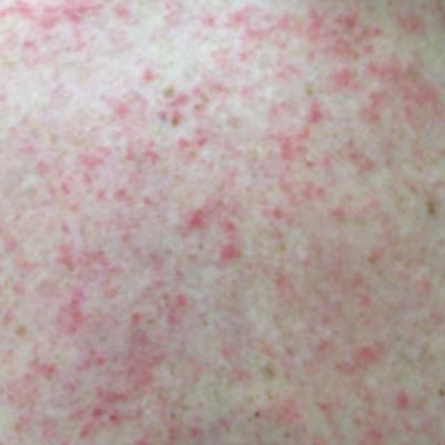 Anastrozole-Induced Subacute Cutaneous Lupus Erythematosus | MDedge ...