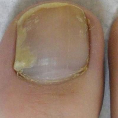 Subungual Onycholemmal Cyst of the Toenail Mimicking Subungual Melanoma ...