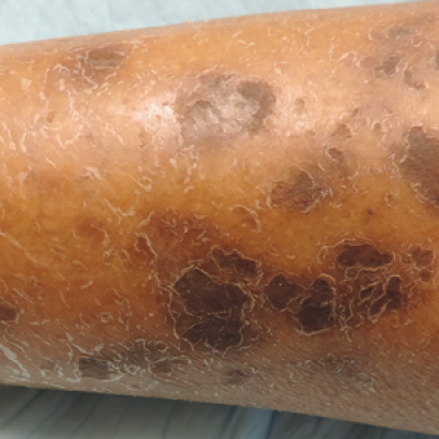 Ichthyosiform Sarcoidosis and Systemic Involvement | MDedge Dermatology