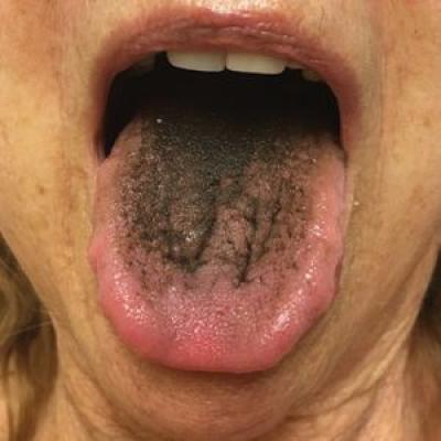 Womans tongue suddenly grows hairy after she was involved in a crash   Metro News