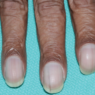 Unilateral Nail Clubbing in a Hemiparetic Patient | MDedge Dermatology