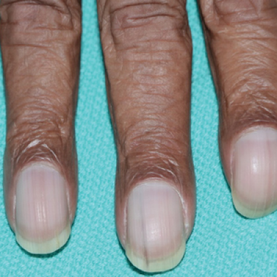 Unilateral Nail Clubbing In A Hemiparetic Patient Mdedge Dermatology