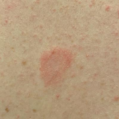 Pityriasis Rosea Associated With COVID-19 Vaccination: A Common Rash ...