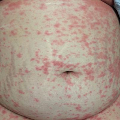 Psoriasis in Pregnancy | MDedge Dermatology