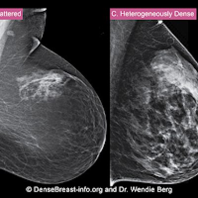 How is a woman determined to have dense breast tissue? | MDedge ObGyn