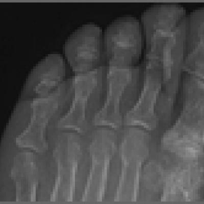 Emergency Imaging: Right hallux pain | MDedge Emergency Medicine