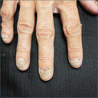 Allergies | Free Full-Text | Contact Dermatitis in Nail Cosmetics