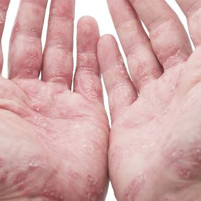 Survey: Psoriasis/psoriatic arthritis undertreated | MDedge Rheumatology