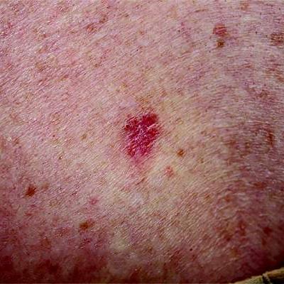 Higher risk of basal cell carcinoma linked to menopausal hormone ...