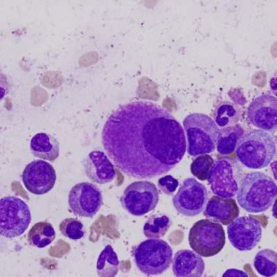 Cml Patients Die From Comorbidities, Not Leukemia 